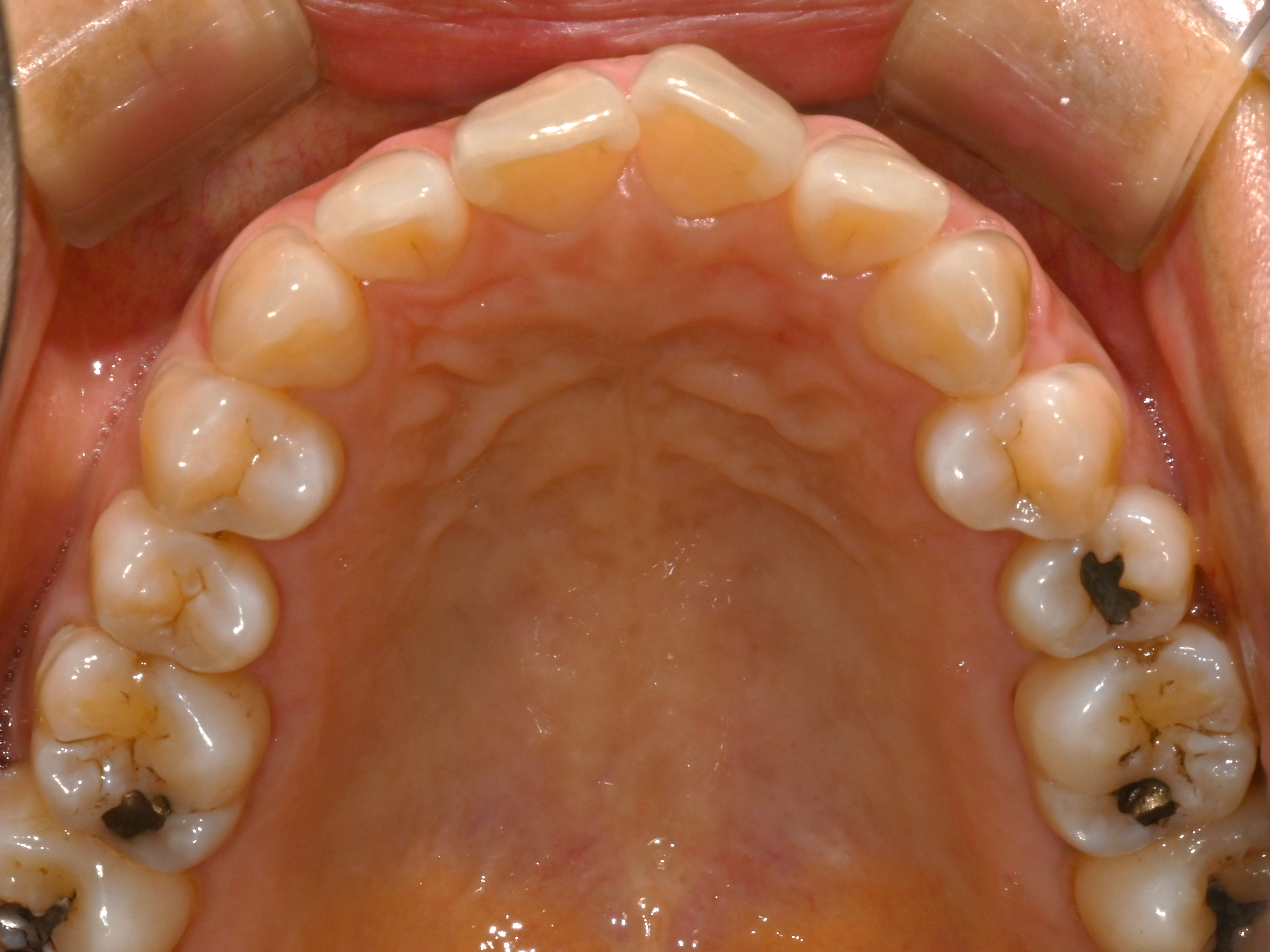 부분 교정 사례 01 상악 교합면 치료 전