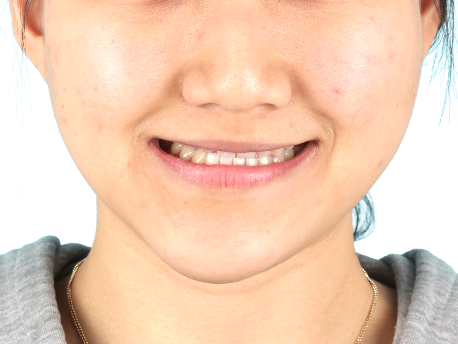 중심선 · 비대칭 사례 02 얼굴 정면 치료 전